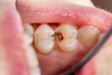 tooth filling material