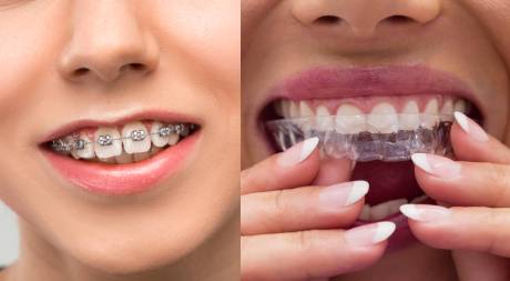 Invisalign vs Braces: Which Choice is Right for You? - Arrow Smile Dental